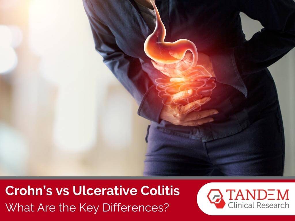 Crohn's Disease vs Ulcerative Colitis Feature Image