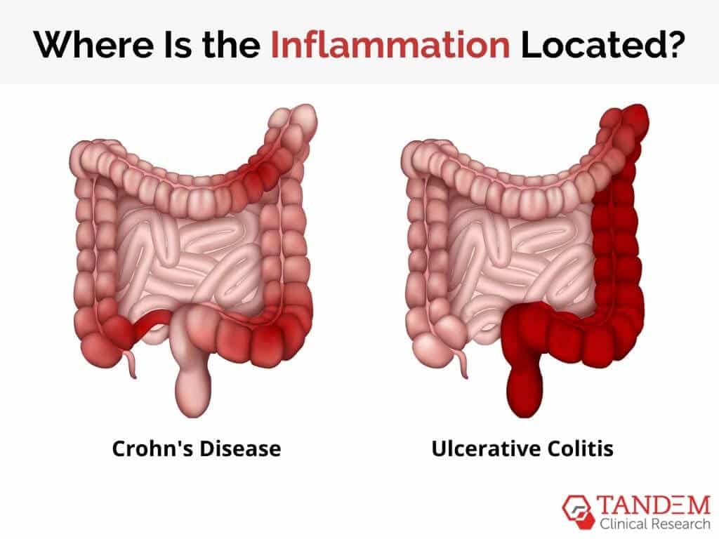 Inflammation located