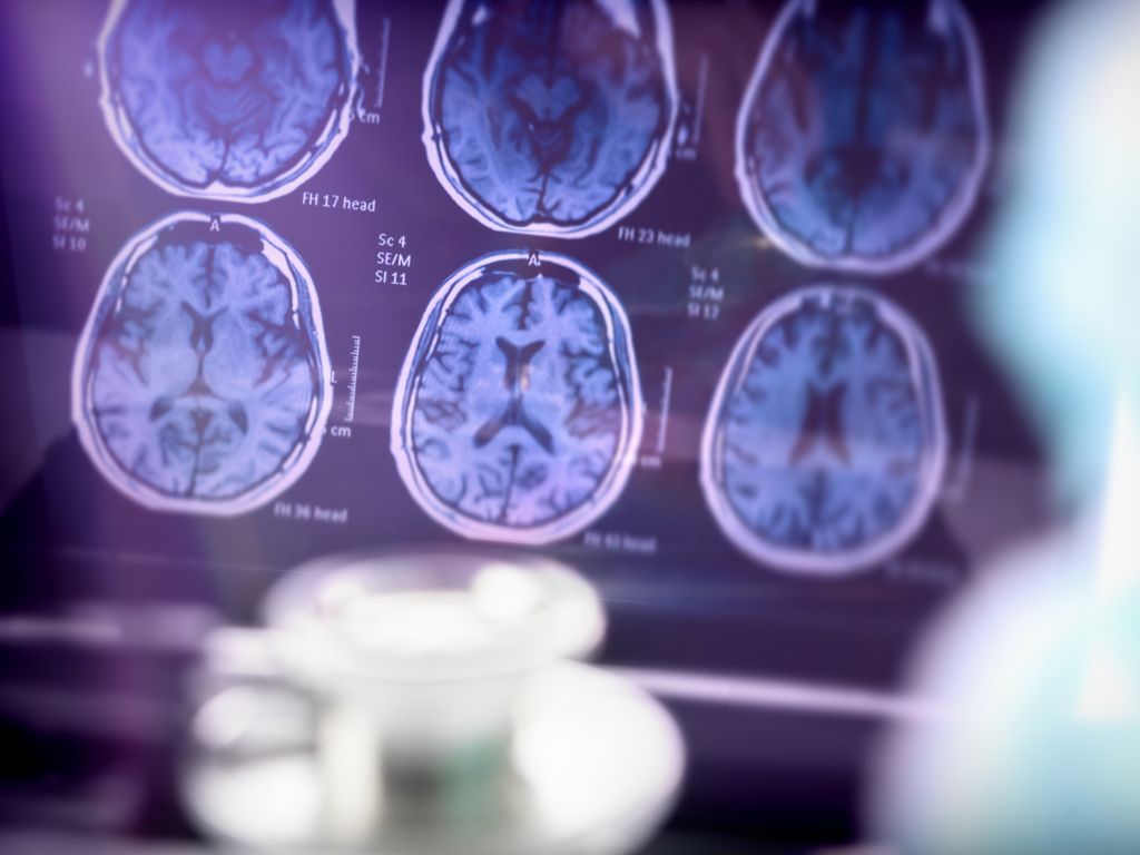 Brain imaging of alzheimer's disease patient