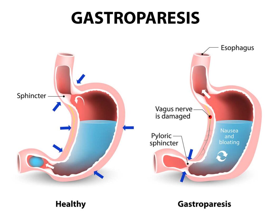 What is gastroparesis