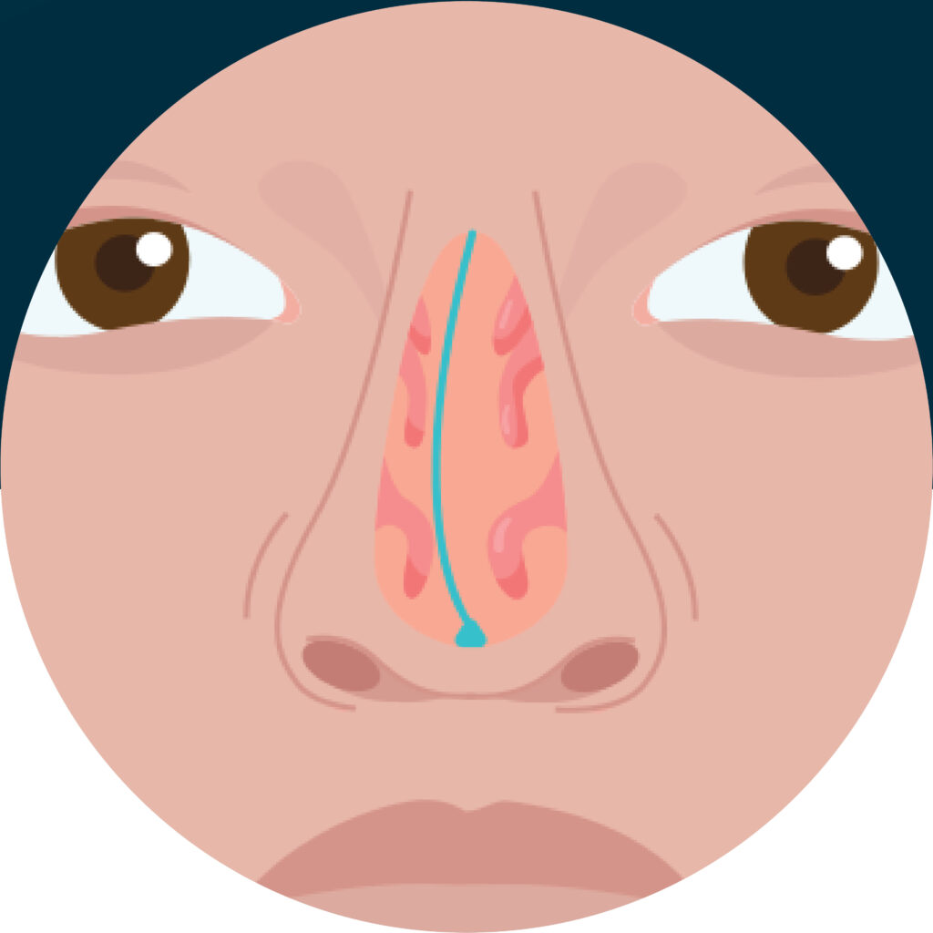 Deviated nasal septum face